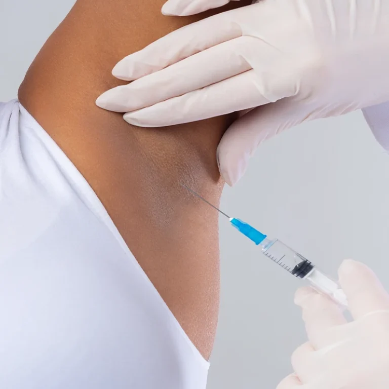 BotoxForHyperhidrosis